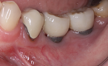 Cómo saber si hay infección en un Implante Dental